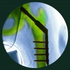 Pinned перелом стегна — стокове фото