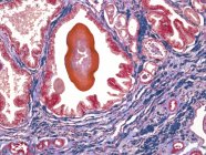 Prostata che mostra una concrezione di materiali secretori — Foto stock
