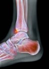 Coloured X-ray of the foot of a 22-year-old male patient with a spur (osteophyte, highlighted) affecting the tibia (shin bone). — Stock Photo