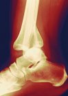 X-ray showing a fractured tibia — Stock Photo