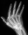 Anatomía de la mano artrítica - foto de stock