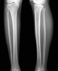 Anatomia normale della parte inferiore delle gambe, radiografia frontale . — Foto stock