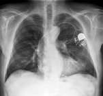 Patient with a heart pacemaker — Stock Photo