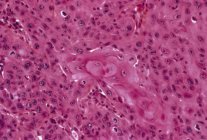 Carcinoma epidermoide cáncer de piel - foto de stock