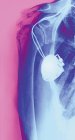 Серце кардіостимулятора, рентген — стокове фото