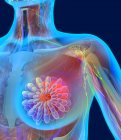 Злокачественная опухоль в женской груди — стоковое фото