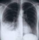Pneumonie. Radiographie de la poitrine d'un patient présentant une pneumonie bactérienne (zone blanche granuleuse, en bas à gauche) dans le lobe inférieur du poumon droit (gauche ). — Photo de stock