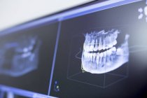 Gros plan sur les radiographies dentaires en clinique dentaire . — Photo de stock