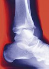 Radiografia che mostra una tibia fratturata — Foto stock