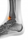 Farbiges Röntgenbild des Fußes eines 22-jährigen Patienten mit einem Schienbeinbruch (Osteophyt, hervorgehoben)). — Stockfoto