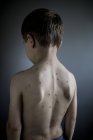Niño con manchas de varicela en la espalda . - foto de stock