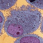 Leukaemia cells in a patient with Bloom's syndrome, coloured transmission electron micrograph (TEM). — Stock Photo