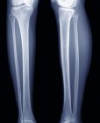Anatomía normal de las piernas inferiores, radiografía frontal
. - foto de stock