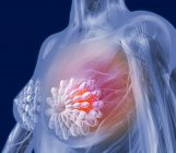 Tumeur maligne chez une femme sein — Photo de stock