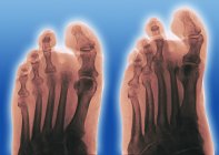 Coloured frontal (left) and oblique (right) X-rays of a foot of a diabetic, showing an amputated second toe. — Stock Photo