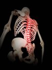 Inflammation of the human spine — Stock Photo
