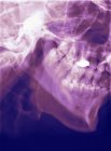 Coloured profile X-ray of a human mandible (lower jaw). — Stock Photo