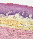 Micrografía ligera de una sección a través de la piel con un tumor de neurofibroma (rosa, en la parte inferior) ). - foto de stock