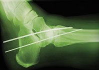 Vorübergehende Ruhigstellung des Knöchels, farbiges Profil röntgen. — Stockfoto