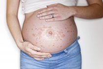 Pregnant woman touching rash on tummy — Stock Photo