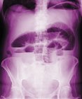 Кольоровий фронтальний рентгенівський знімок заблокованої кишки (верхній центр ). — стокове фото