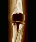 Prothèse d'articulation du genou — Photo de stock