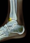 Radiografía coloreada del pie de un paciente masculino de 22 años con un espolón (osteófita, resaltado) que afecta a la tibia (hueso de la espinilla ). - foto de stock