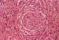 Micrografía ligera de una sección del tejido estomacal que muestra una lesión (centro) causada por una úlcera gástrica . - foto de stock
