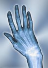 Anatomia della mano artritica — Foto stock