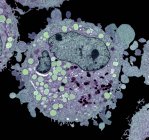 Célula de carcinoma, micrografia electrónica de transmissão colorida (MET ). — Fotografia de Stock