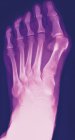 Farbiges Röntgenbild einer Ballenunion, die Schwellung des Gelenks zwischen der Großzehe und dem ersten Mittelfußknochen. — Stockfoto