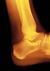 Normal ankle joint, coloured profile X-ray. — Stock Photo