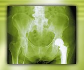 Total hip replacement — Stock Photo