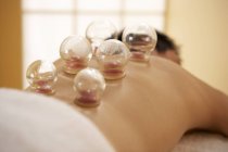Close-up of heated cups on client back for cupping therapy. — Stock Photo