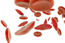 Sickle cell anaemia — Stock Photo