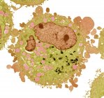 Célula de carcinoma, micrografía electrónica de transmisión de color (TEM) ). - foto de stock