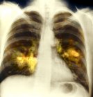 Raggi X colorati che mostrano il cancro nel polmone sinistro di un paziente di 55 anni . — Foto stock