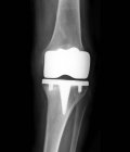 Protesi articolare del ginocchio — Foto stock