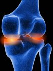 Inflamed knee cartilage — Stock Photo
