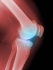 Coloured X-ray of arthritic knees — Stock Photo