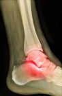 Tornozelo do paciente com osteoartrite — Fotografia de Stock
