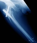 Perna partida presa, raio-X — Fotografia de Stock
