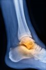Ankle of patient with osteoarthritis — Stock Photo