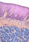 Basal cell carcinoma — Stock Photo