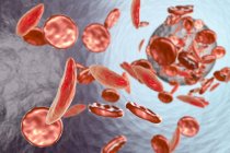 Серповидноклеточная анемия — стоковое фото