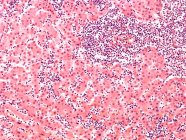 Micrografía ligera de células sanguíneas (principalmente células B, púrpura oscuro) en el hígado de un paciente con leucemia linfocítica . - foto de stock