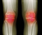 Coloured X-ray of arthritic knees — Stock Photo