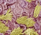 Цветной сканирующий электронный микрограф (СЭМ) аденокарциномы (рака) матки . — стоковое фото