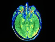 Image par résonance magnétique (IRM) fausse couleur d'une section axiale à travers une tête humaine, montrant la division du gros du cerveau en hémisphères cérébraux gauche et droit . — Photo de stock