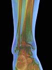 Normal ankle joint, coloured frontal X-ray. — Stock Photo